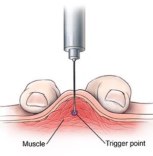 dryneedling